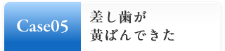 Case05:差し歯が黄ばんできた