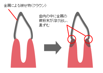 メタルタトゥ症例イメージイラスト