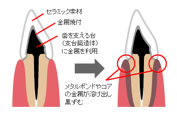 メタルタトゥ症例イメージイラスト2