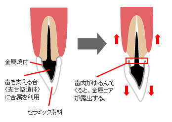 メタルライン露出の症例写真