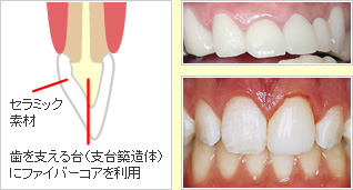 オールセラミック治療イメージ
