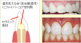 オールセラミック治療イメージ