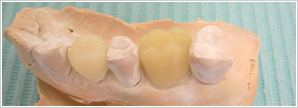 歯科形成物のイメージ